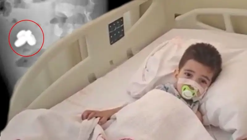 Çocuğun Pili ve Mıknatısı Yutması Bağırsaklarına Zarar Verdi: Olayın Ayrıntıları